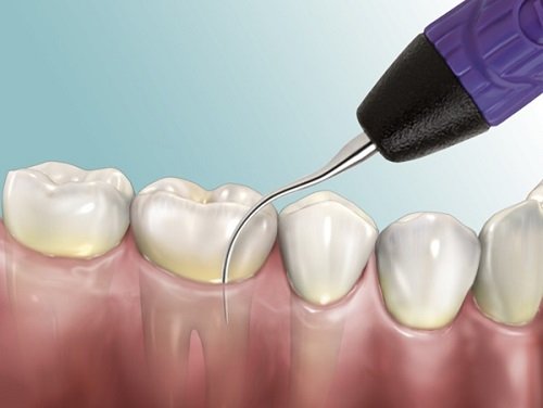 Cạo vôi răng được khuyên nên áp dụng ít nhất 6 tháng 1 lần