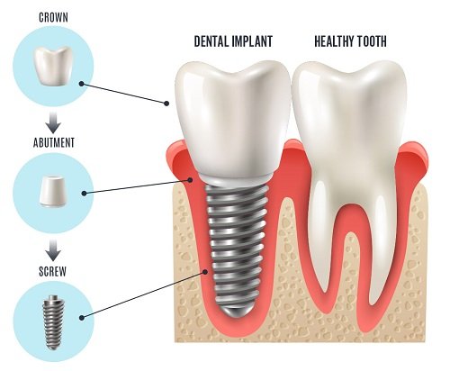 Có nên trồng răng sứ không? Tìm hiểu về răng sứ 4