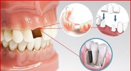 Trồng răng cửa hàm trên nên áp dụng kỹ thuật nào? 1