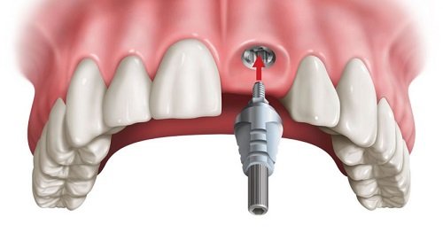 Trồng răng cửa hàm trên nên áp dụng kỹ thuật nào? 2