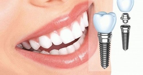 Trồng răng cửa hàm trên nên áp dụng kỹ thuật nào? 3