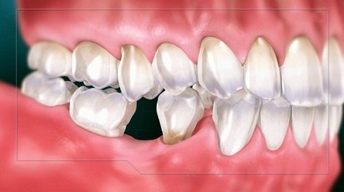 Trồng răng giả hàm dưới bạn cần phải lưu ý điều gì?
