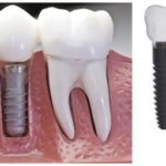 Implant phương pháp trồng răng hiệu quả