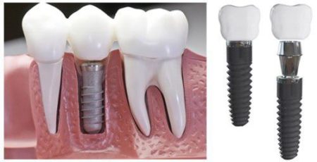 Implant phương pháp trồng răng hiệu quả