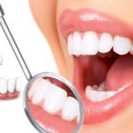 Trồng răng sứ có bền không? Yếu tố nào quyết định
