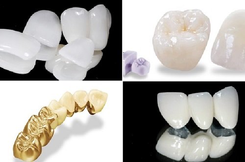Trồng răng sứ có bền không? Yếu tố nào quyết định 3