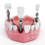 Trồng răng có ảnh hưởng gì không? Tìm hiểu về dịch vụ trồng răng