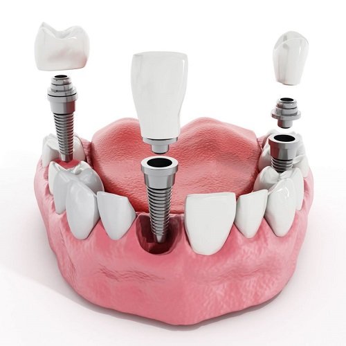 Trồng răng có ảnh hưởng gì không? Tìm hiểu về dịch vụ trồng răng 1