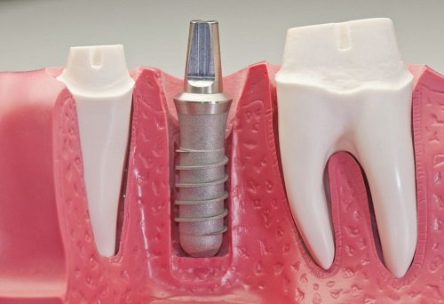 Trồng răng có ảnh hưởng gì không? Tìm hiểu về dịch vụ trồng răng 2