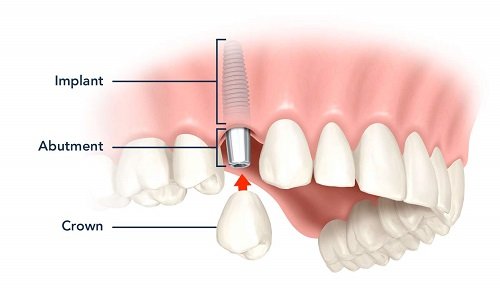 Trồng răng có ảnh hưởng gì không? Tìm hiểu về dịch vụ trồng răng 3
