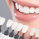 Làm răng sứ không mài răng - Thông tin bạn cần tìm hiểu
