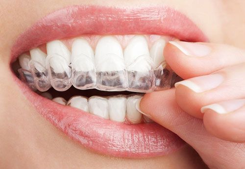 Niềng răng nhanh nhất bao lâu? Cần lưu ý gì khi niềng răng? 2