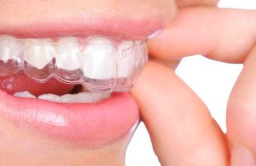 Niềng răng nhanh nhất bao lâu? Cần lưu ý gì khi niềng răng? 3