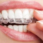 Niềng răng không mắc cài mất bao lâu? Các vấn đề bạn nên biết