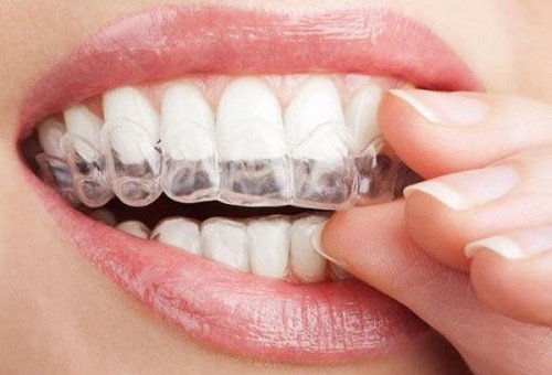 Niềng răng không mắc cài mất bao lâu? Các vấn đề bạn nên biết 1