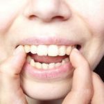 Có nên tự tẩy trắng răng ở nhà không?