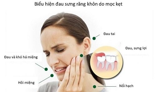 Nhổ răng khôn giá bao nhiêu? Chi phí nhổ răng 2