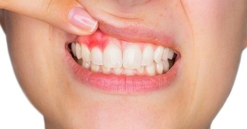 Răng sứ gây sưng lợi làm ảnh hưởng tới sức khỏe răng miệng