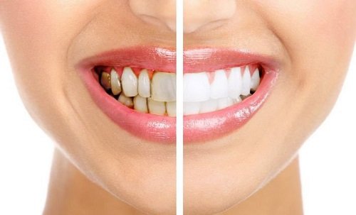 Tẩy trắng răng bị nhiễm tetracycline cho bạn hiệu quả 1