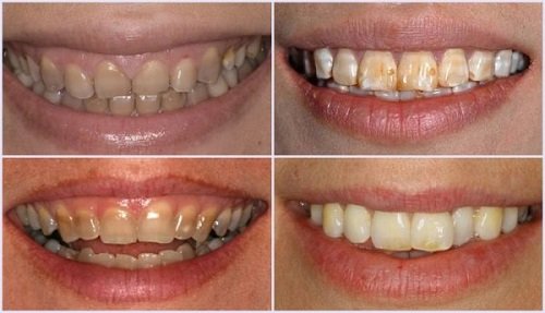 Tẩy trắng răng bị nhiễm tetracycline cho bạn hiệu quả 2