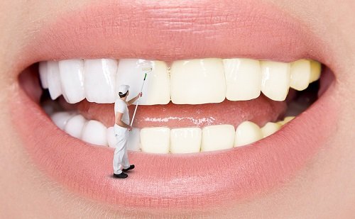 Có nên tẩy trắng răng nhiều lần hay không? 1