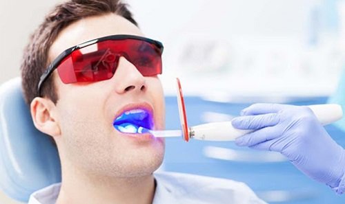 Có nên tẩy trắng răng nhiều lần hay không? 2