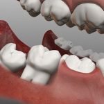 Nhổ răng khôn giá bao nhiêu tiền? Chi phí nhổ răng khôn