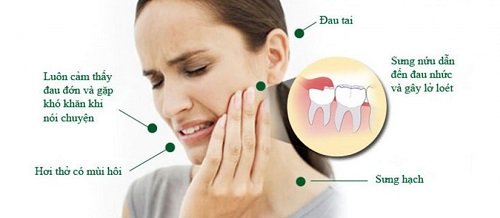 Răng khôn bị mọc lệch - Cách khắc phục hiệu quả 1