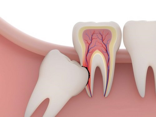 Răng khôn bị mọc lệch - Cách khắc phục hiệu quả 2
