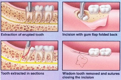 Răng khôn bị mọc lệch - Cách khắc phục hiệu quả 3