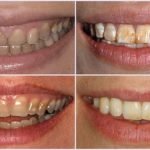 Tẩy trắng răng có ảnh hưởng gì không? Tham khảo