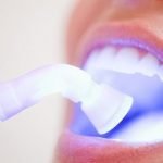 Một số điều cần biết khi tẩy trắng răng
