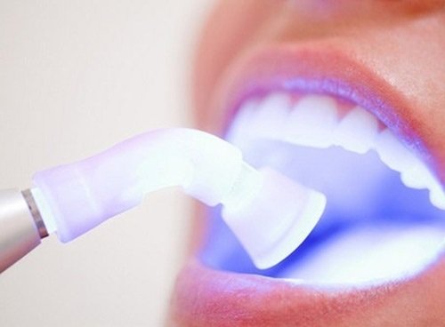 Tẩy trắng răng có ảnh hưởng gì không? Tham khảo 2