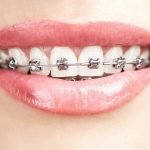 Niềng răng xong có nên tẩy trắng răng?