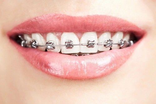 Niềng răng xong có nên tẩy trắng răng? Nha khoa tư vấn 1