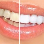 Răng sứ zirconia có bền không tại cơ sở Nha Khoa?