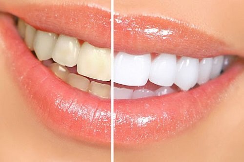 Niềng răng xong có nên tẩy trắng răng? Nha khoa tư vấn 2