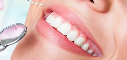 Dấu hiệu răng sứ bị hở - Cách khắc phục 3