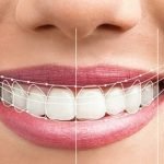 Bọc răng sứ hiệu quả nhất tại Tp HCM như thế nào?