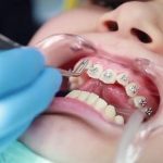 Tẩy trắng răng bằng công nghệ BleachBright
