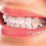 Những câu hỏi về răng sứ thường gặp hiện nay là gì?