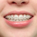 Niềng răng móm bao lâu? Thông tin cần biết trước khi niềng răng