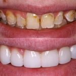 Làm thế nào để khắc phục răng nhiễm màu nặng?
