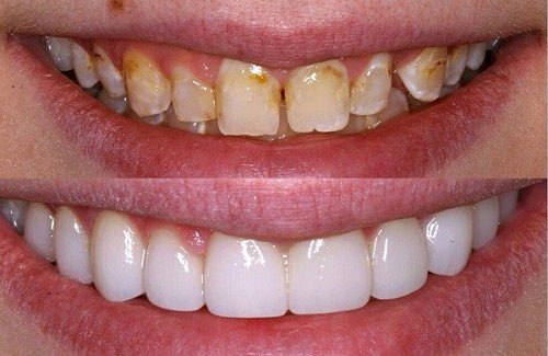 Răng sứ bị hỏng là do yếu tố nào gây nên? 1