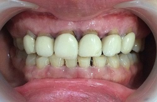 Răng sứ bị hỏng là do yếu tố nào gây nên? 2