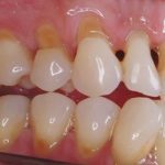 Răng sứ bị mòn - Dấu hiệu giúp bạn nhận biết xử lý