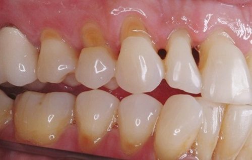 Răng sứ bị mòn - Dấu hiệu nhận biết xử lý 1
