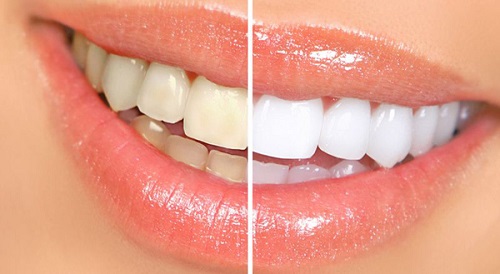 Tẩy trắng răng bằng đèn plasma có hại không? Giải đáp 1