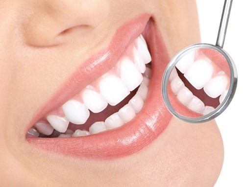 Tẩy trắng răng duy trì được bao lâu? Cần kiêng cử gì? 1