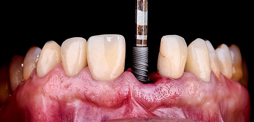 Trồng răng implant có nguy hiểm không? Biến chứng ra sao? 2